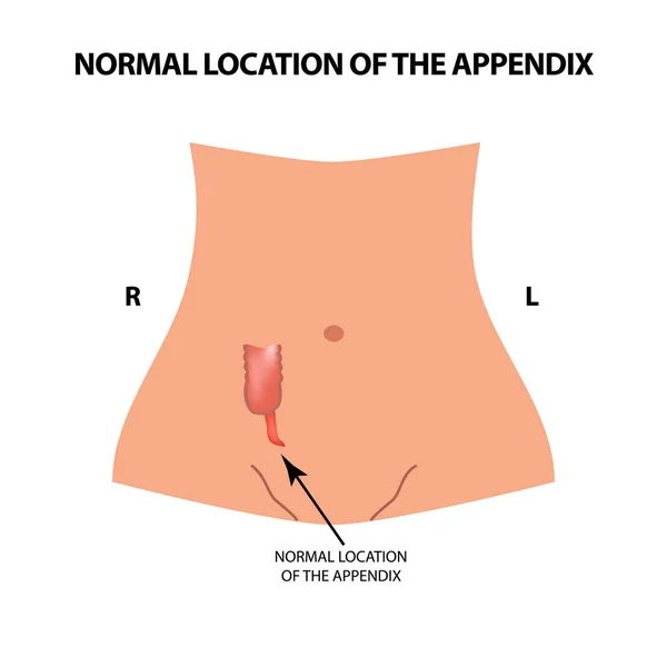 The normal location of the appendix. Vector illustration on isolated background. — Stock Vector