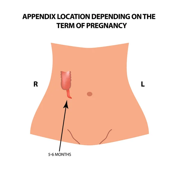Die Lage des Blinddarms hängt von der Dauer der Schwangerschaft ab. 5-6 Monate. Infografiken. Vektor-Illustration auf isoliertem Hintergrund. — Stockvektor