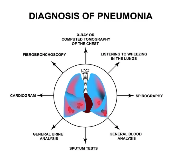 Diagnóza pneumonie. Lidské dýchací orgány. Světový den pneumonie. Anatomická struktura zanícených plic. Infographics. Vektorová ilustrace na izolovaném pozadí. — Stockový vektor