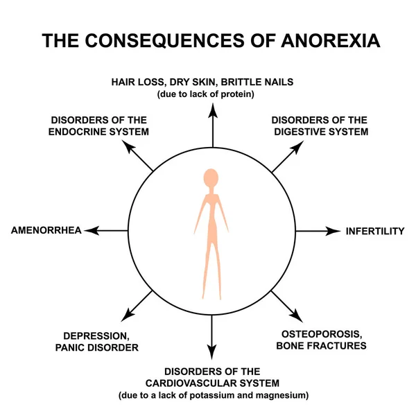 Důsledky anorexie. Slabá postava s anorexií. Infographics. Vektorová ilustrace na izolovaném pozadí. — Stockový vektor