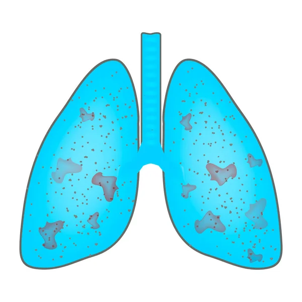 Lungor som drabbats av lunginflammation. Världspneumonidagen. Lungornas anatomiska struktur. Infografik. Vektor illustration på isolerad bakgrund. — Stock vektor