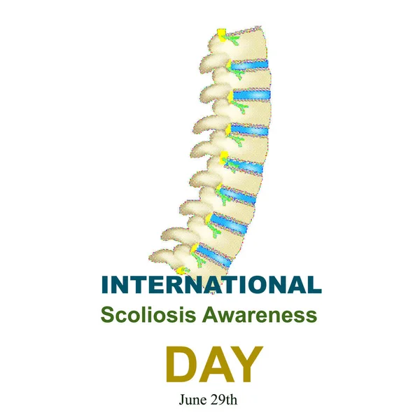 Día Mundial de la Escoliosis. Escoliosis de la columna vertebral. Infografías. Ilustración vectorial sobre fondo aislado . — Vector de stock
