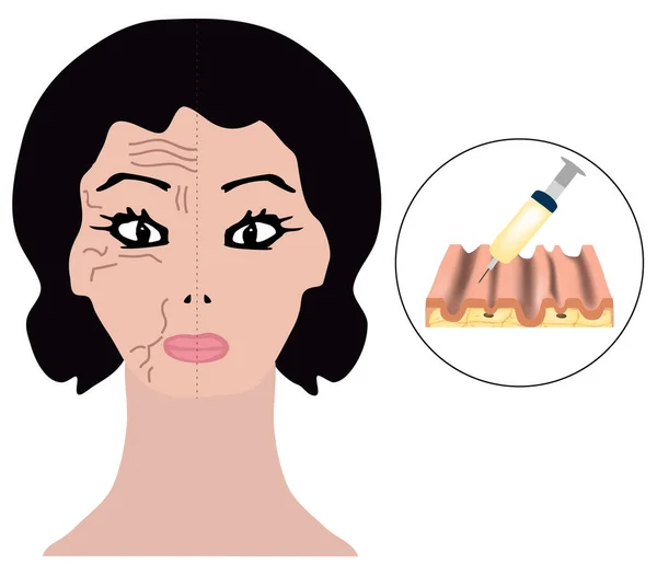 Rynkor på ena halvan av ansiktet. Botox behandling. Botox injektioner. Infographics. Vektor illustration på isolerad bakgrund. — Stock vektor
