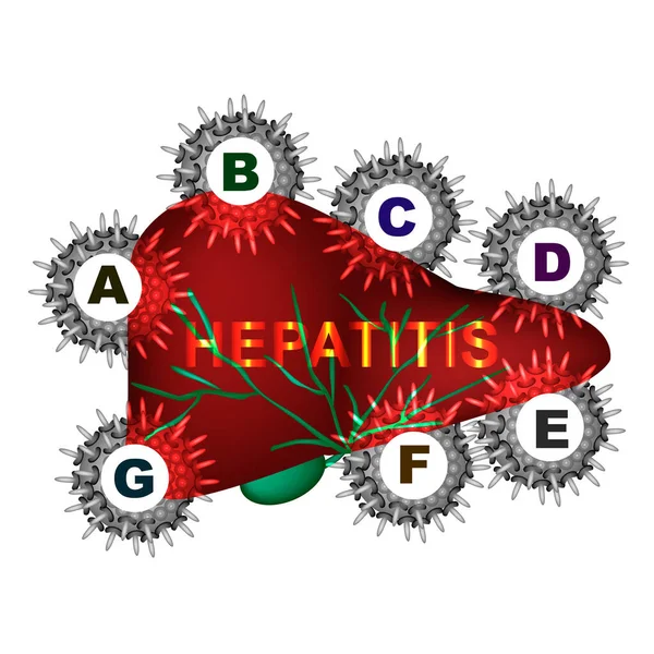 Tipos de hepatitis viral. Hepatitis A, B, C, D, E, F, G. Día Mundial de la Hepatitis. Infografías. Ilustración vectorial sobre fondo aislado . — Vector de stock