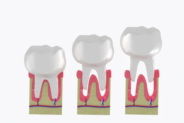Extracción molar. Pérdida de dientes Estructura anatómica. 3d ilustración médica . —  Fotos de Stock
