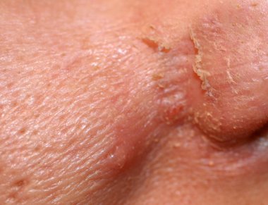 Yüzünde iltihaplı deri var. Sivilce. Deride sivilceler. Yaralar ve soyulmalar..