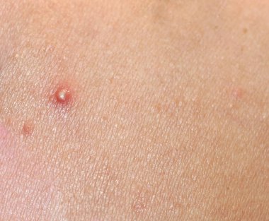 Yüzünde iltihaplı deri var. Sivilce. Deride sivilceler. Yaralar ve soyulmalar..