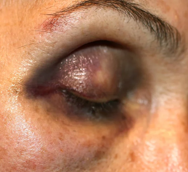 A bruise near the eye. Hematoma on the face from a blow. Eye injury. — Stock Photo, Image