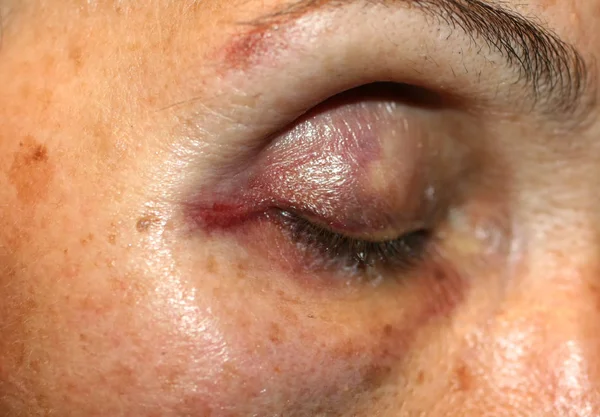Egy zúzódás a szem közelében. Hematóma az arcon egy ütéstől. Szemkárosodás. — Stock Fotó