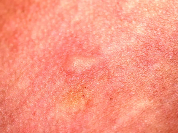 Eczema de piel inflamada, psoriasis, seborrea. inflamación de la piel . — Foto de Stock