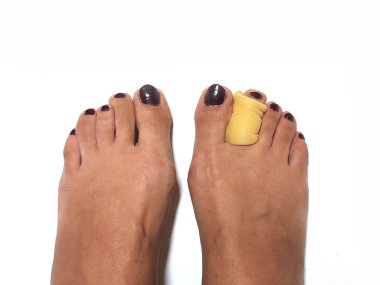 Toe Corrector Silicone Valgus Big Bunion Splint Straightener Foot. silicone support for orthopedic. clipart