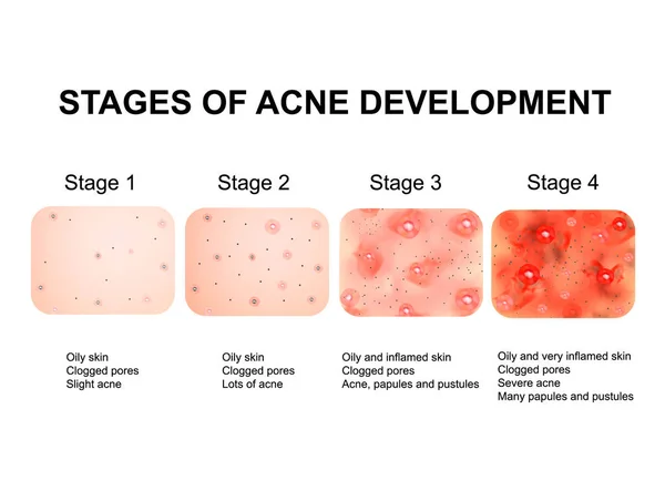 Этапы развития акне. Воспаленная кожа со шрамами, прыщами и прыщами. Текстура воспаленной кожи, прыщи и прыщи. Инфографика. Векторная иллюстрация . — стоковый вектор