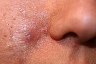 Yüzünde iltihaplı deri var. Sivilce. Deride sivilceler. Yaralar ve soyulmalar..