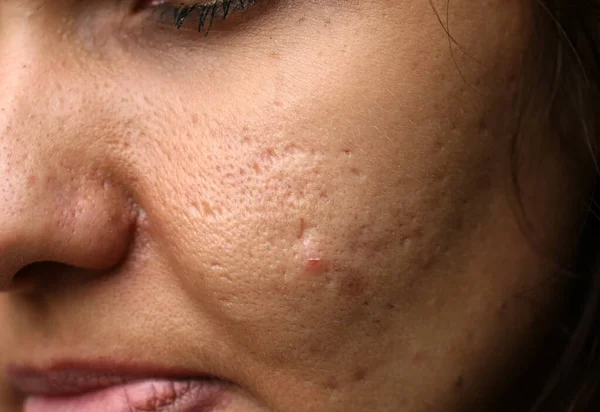 Inflamed skin on the face. Acne. Pimples on the skin. Scars and peeling. — Stock Photo, Image