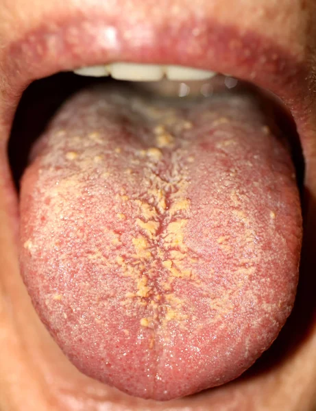 冲到舌头上。 地理语言。 念珠菌病. — 图库照片