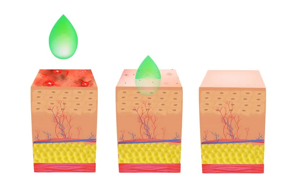 Peeling per l'acne. Acne cutanea infiammata. Acne purulenta. La struttura anatomica della pelle. Infografica. Illustrazione vettoriale su sfondo isolato . — Vettoriale Stock