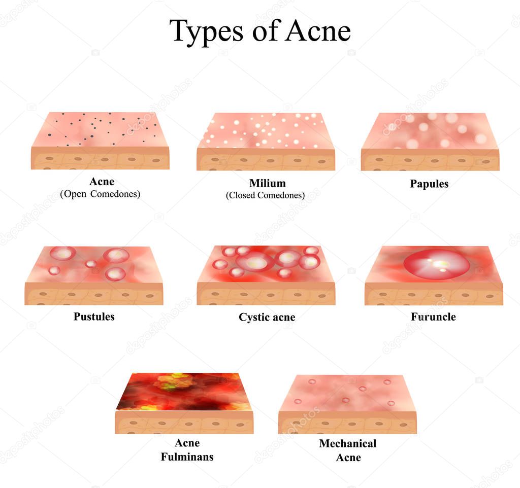 Types of Acne Skin inflammation. Pimples, boils, whitehead, closed comedones, papules, pustules, cystic acne. Infographics. Vector illustration on isolated background.