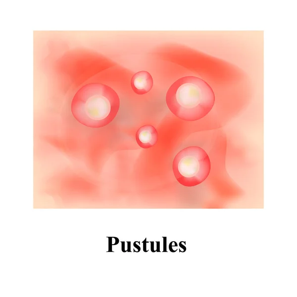 Pustole sulla pelle. Acne. Brufoli sulla pelle. Infografica. Illustrazione vettoriale . — Vettoriale Stock