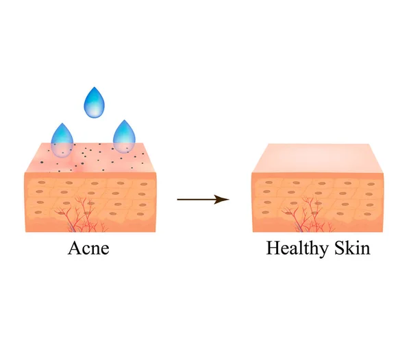 Acne behandeling met zure peeling. Zwarte plekken van mee-eters op de huid. Acne zwart. Slechte reiniging. De anatomische structuur van de huid met acne. Vectorillustratie op geïsoleerde achtergrond. — Stockvector