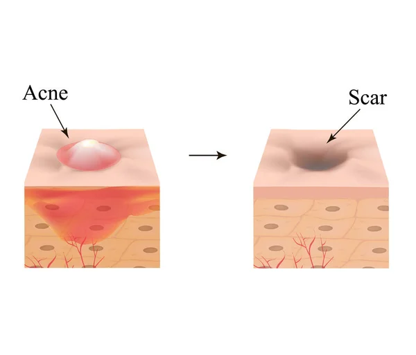 Acne inflamada na pele. Espinha inflamada. A estrutura da pele. Cicatriz de acne. Infográficos. Ilustração vetorial sobre fundo isolado . —  Vetores de Stock