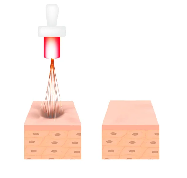 Cicatrici da acne. Trattamento atrofico della cicatrice laser. La struttura anatomica della pelle con acne. Illustrazione vettoriale su sfondo isolato . — Vettoriale Stock