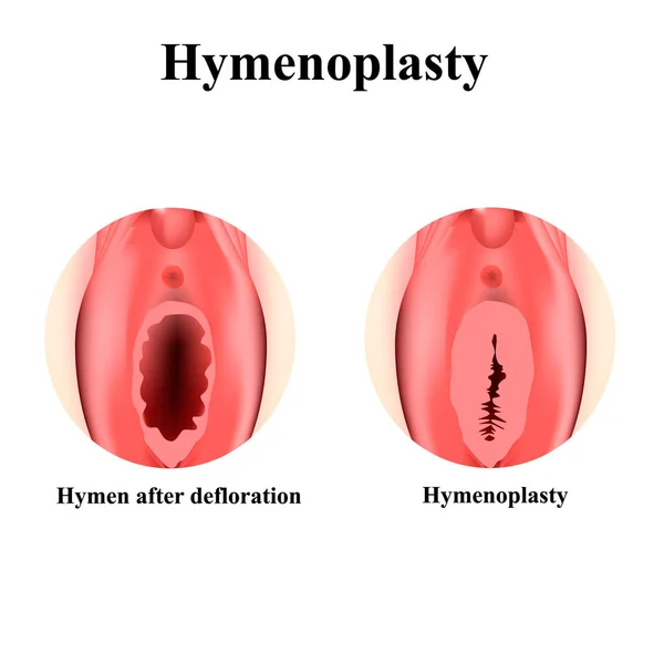 The structure of the vulva hymen. Hymenoplasty. Hymen after defloration. Female genital organs. Infographics. Vector illustration on isolated background. — Stock Vector