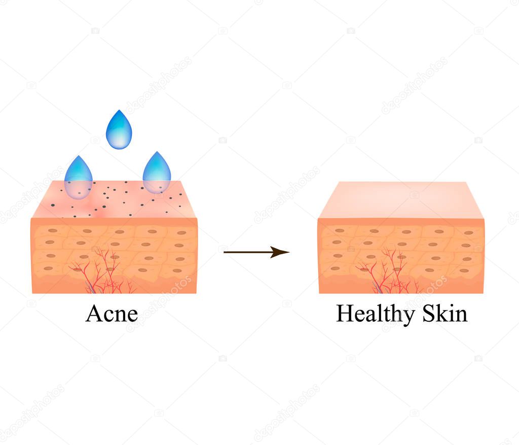 Acne treatment with acid peeling. Black spots of blackheads on the skin. Acne black. Pore cleansing. The anatomical structure of the skin with acne. Vector illustration on isolated background.