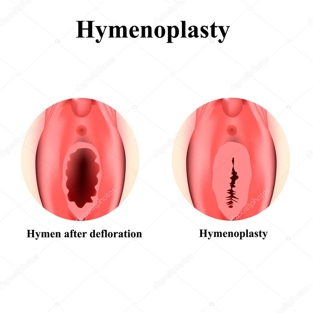 The structure of the vulva hymen. Hymenoplasty. Hymen after defloration. Female genital organs. Infographics. Vector illustration on isolated background.