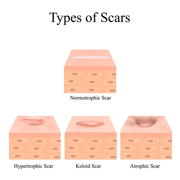 Yara izleri. Sivilce izleri. Keloid, hipertrofik, atrofik, normotrofik. Sivilceli derinin anatomik yapısı. İzole edilmiş arkaplanda vektör illüstrasyonu. — Stok Vektör