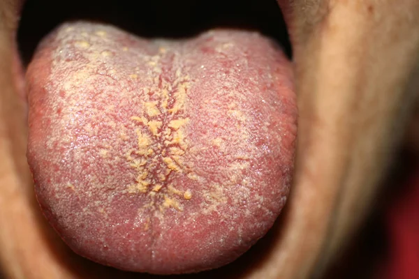 Thrush on the tongue. Geographic tongue. Candidiasis. — Stock Photo, Image