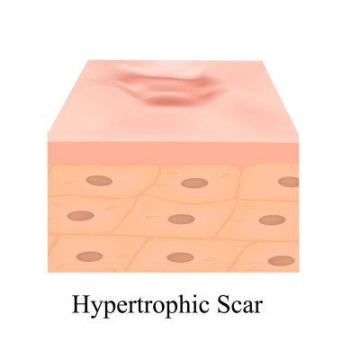 Scars hypertrophic. The anatomical structure of the skin scar. Vector illustration on isolated background. clipart