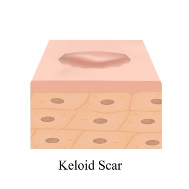 Scars Keloid. The anatomical structure of the skin scar. Vector illustration on isolated background. clipart
