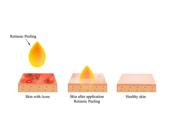 Peeling retinoico per l'acne. Acne cutanea infiammata. Acne purulenta. La struttura anatomica della pelle. Infografica. Illustrazione vettoriale su sfondo isolato . — Vettoriale Stock