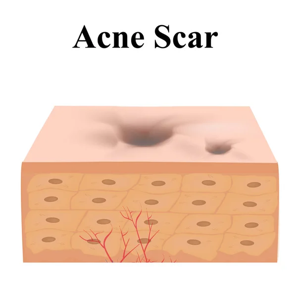 Cicatrizes atróficas. Cicatriz de acne. A estrutura anatômica da pele com acne. Ilustração vetorial sobre fundo isolado . — Vetor de Stock