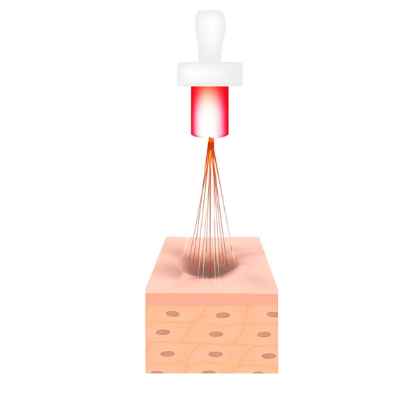 Cicatrices de acné. Tratamiento atrófico de cicatrices láser. Estructura anatómica de la piel con acné. Ilustración vectorial sobre fondo aislado . — Vector de stock