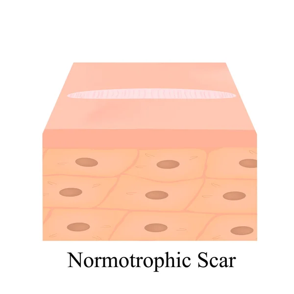 Scars normotrophic. The anatomical structure of the skin scar. Vector illustration on isolated background. — Stock Vector