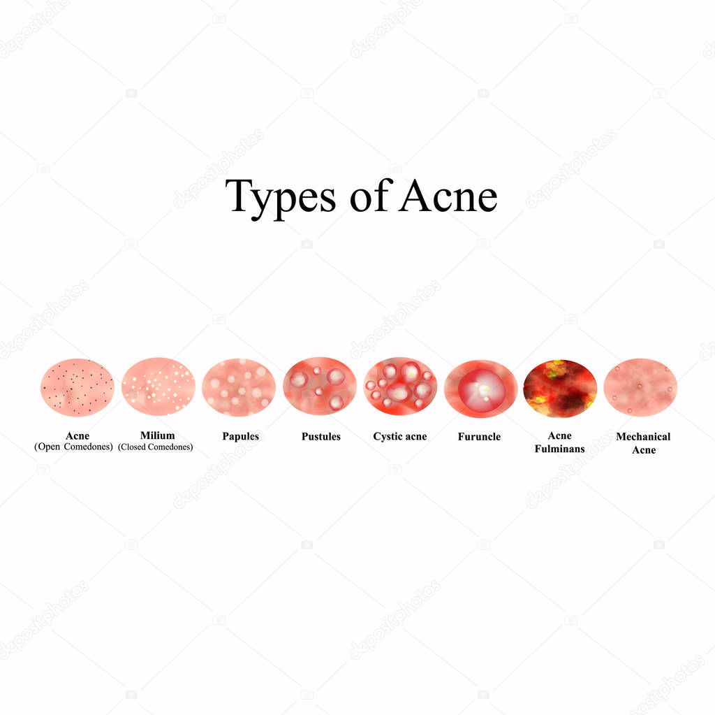 Types of Acne Skin inflammation. Pimples, boils, whitehead, closed comedones, papules, pustules, cystic acne. Infographics. Vector illustration on isolated background.