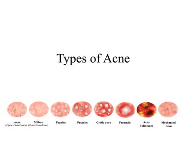 Types of Acne Skin inflammation. Pimples, boils, whitehead, closed comedones, papules, pustules, cystic acne. Infographics. Vector illustration on isolated background. clipart