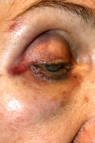 A bruise near the eye. Hematoma on the face from a blow. Eye injury. — Stock Photo, Image