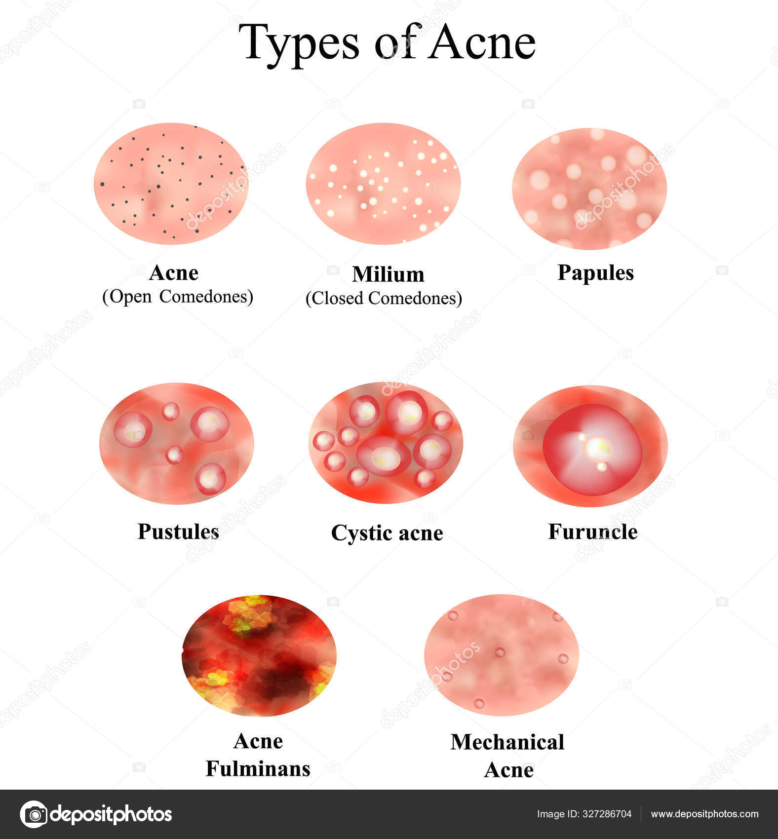 Types of Acne Skin inflammation. Pimples, boils, whitehead, closed ...