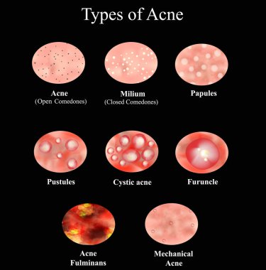 Types of Acne Skin inflammation. Pimples, boils, whitehead, closed comedones, papules, pustules, cystic acne. Infographics. Vector illustration on a black background. clipart