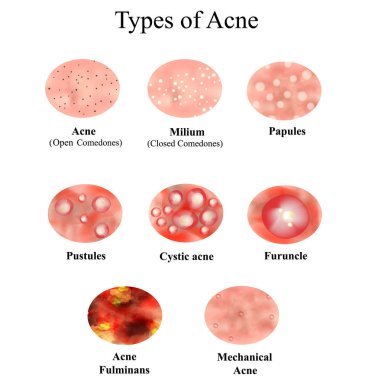 Types of Acne Skin inflammation. Pimples, boils, whitehead, closed comedones, papules, pustules, cystic acne. Infographics. Vector illustration on isolated background. clipart