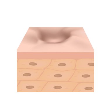 Atrofik yaralar. Sivilce izi. Sivilceli derinin anatomik yapısı. İzole edilmiş arkaplanda vektör illüstrasyonu.