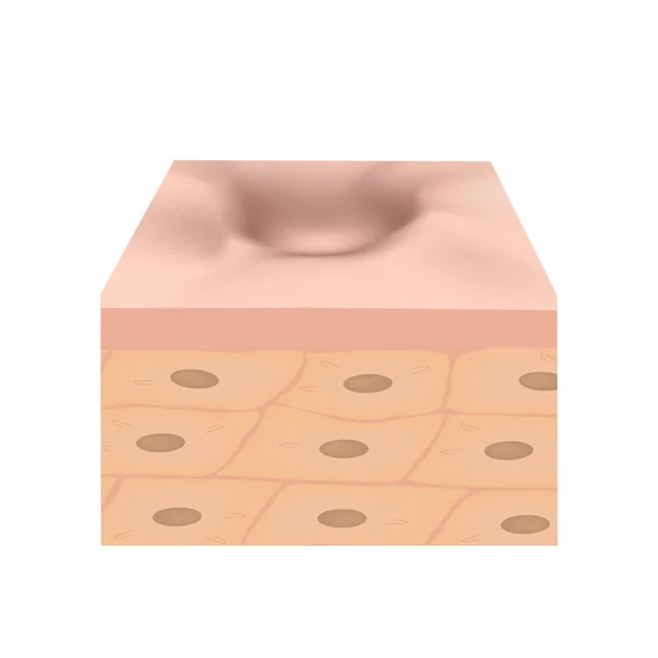 Cicatrizes atróficas. Cicatriz de acne. A estrutura anatômica da pele com acne. Ilustração vetorial sobre fundo isolado . — Vetor de Stock