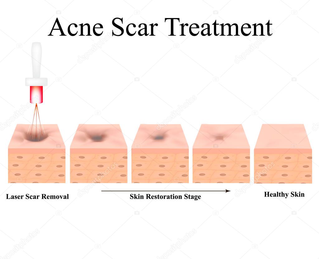 Acne scars. Laser scar atrophic treatment. The anatomical structure of the skin with acne. Vector illustration on isolated background.