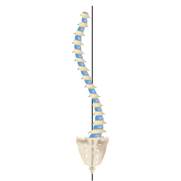 Scoliosi a forma di S. Distroscoliosi. Levoscoliosi. Curvatura spinale, cifosi, lordosi, scoliosi, artrosi. Infografica. Illustrazione vettoriale su sfondo isolato . — Vettoriale Stock