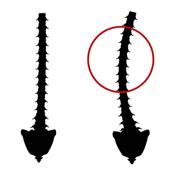 Black and white silhouette icon scoliosis. Spinal curvature, kyphosis, lordosis of the neck, scoliosis, arthrosis. Improper posture and stoop. Infographics Vector illustration on isolated background. — 스톡 벡터