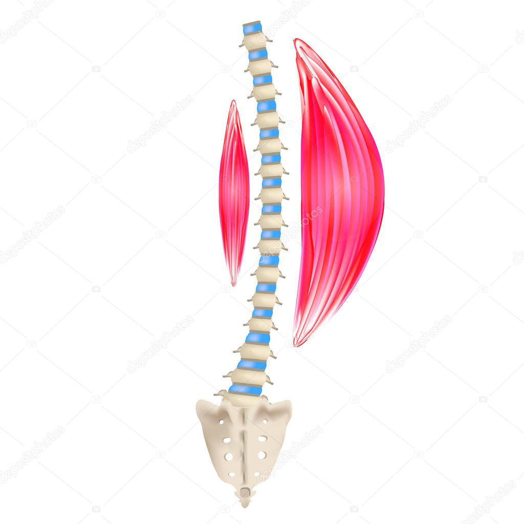 Left-sided scoliosis. Levoscoliosis. Muscles and spine. Spinal curvature in scoliosis. Infographics. Vector illustration on isolated background.