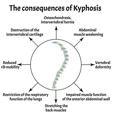 Kyphosis 'in sonuçları. Omurga eğriliği, kifoz, lordosis, skolyoz, artrosis. Uygunsuz duruş ve eğilme. Bilgi grafikleri. İzole edilmiş arkaplanda vektör illüstrasyonu.