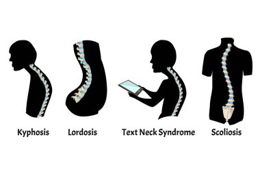 The position of the spine with lordosis, kyphosis. Text Neck Syndrome. Spinal curvature, kyphosis, lordosis, scoliosis, arthrosis. Poor posture and slouching. Infographics. Vector illustration. clipart